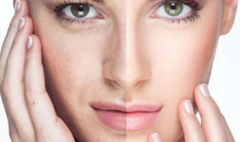 Laser resurfacing